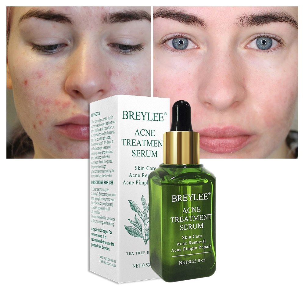 ✨ BREYLEE Acne Treatment Serum ✨