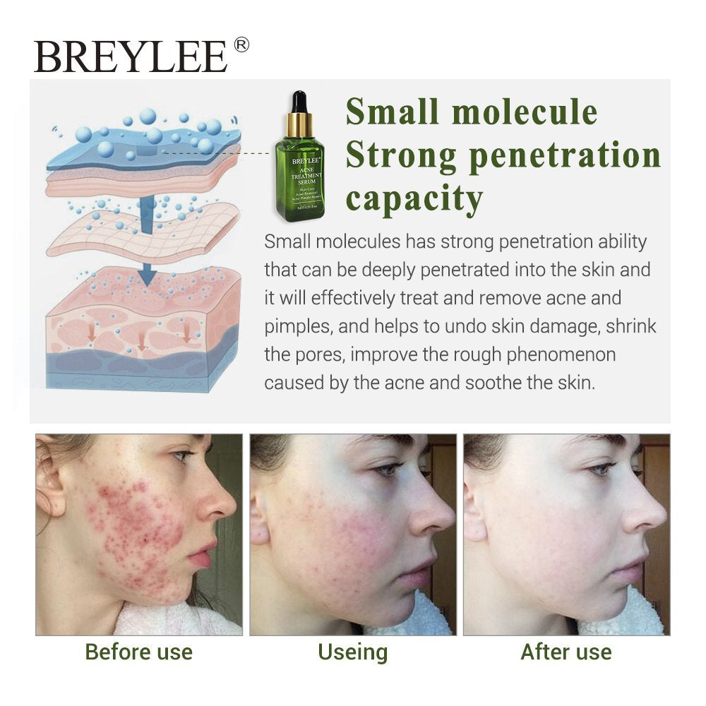 ✨ BREYLEE Acne Treatment Serum ✨