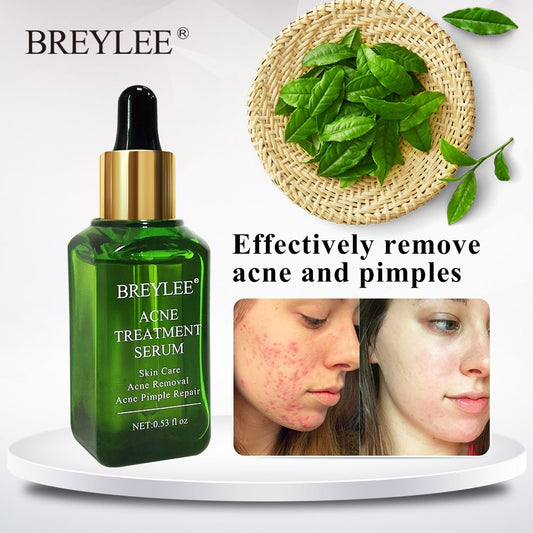 ✨ BREYLEE Acne Treatment Serum ✨