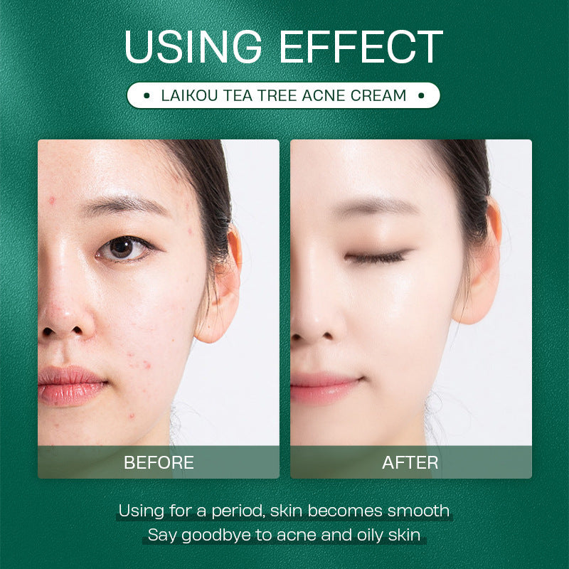 Tea Tree Anti Acne Face Cream 20g Moisturizing Skin Care